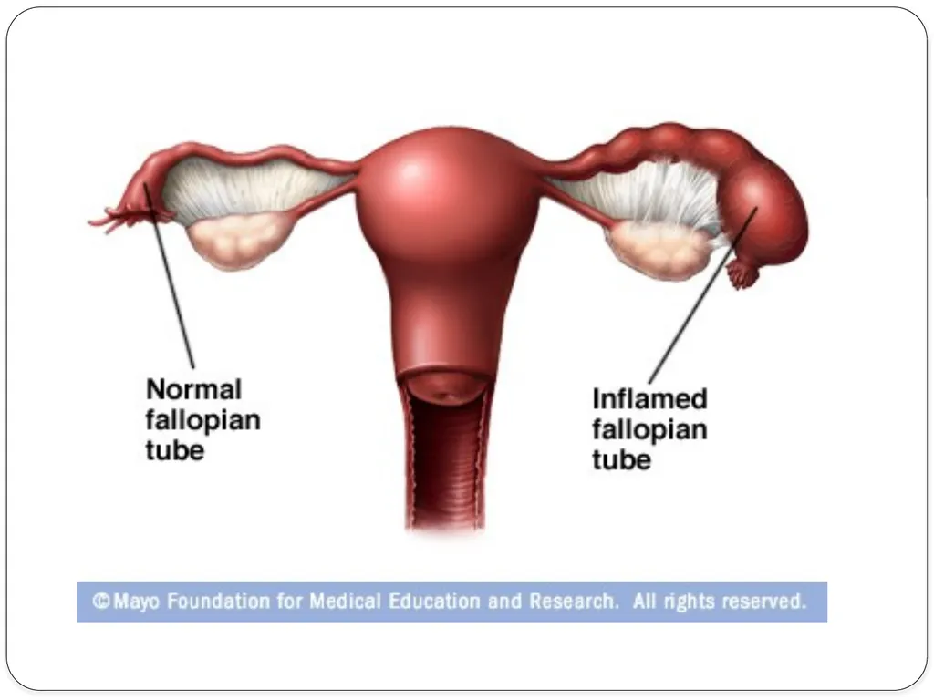Pelvic inflammatory disease prof. Dr. Rabea M. Ali - slide 20 of 44