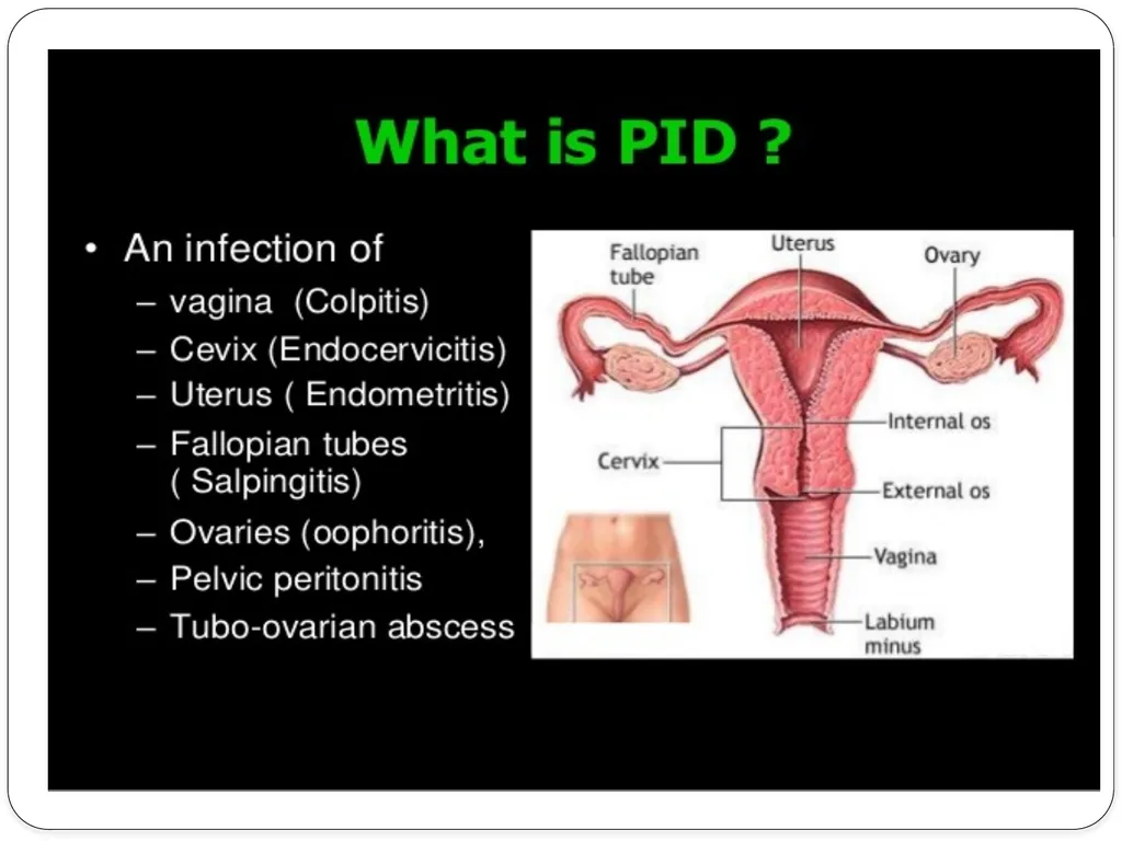 Pelvic inflammatory disease prof. Dr. Rabea M. Ali - slide 3 of 44