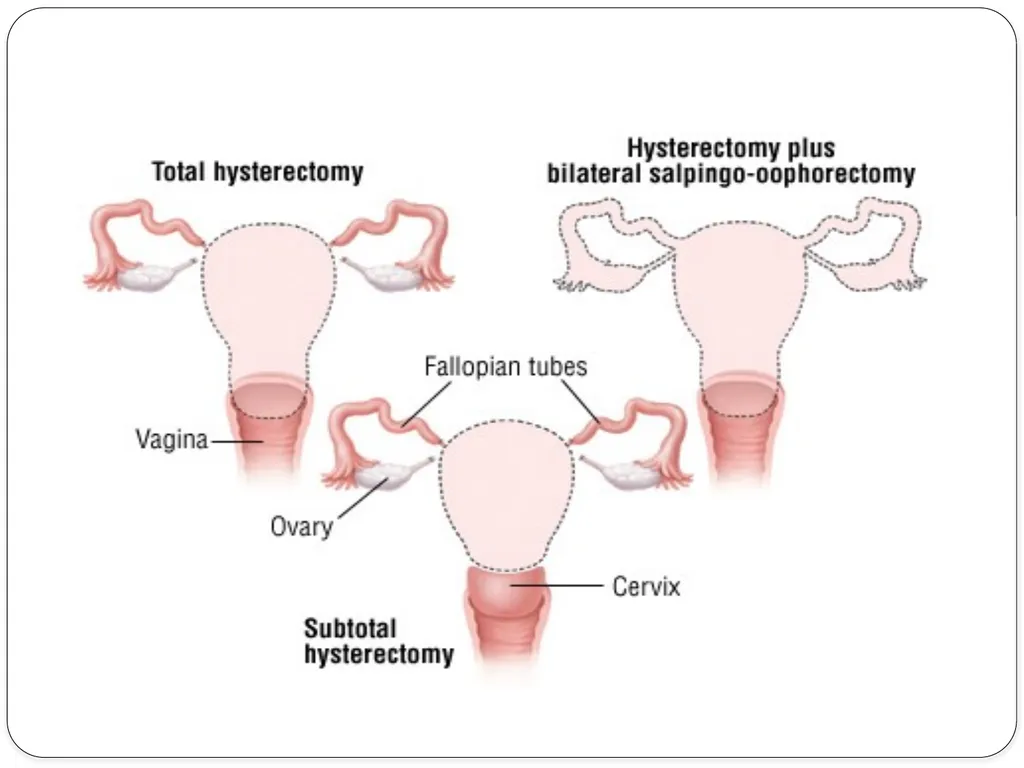 Pelvic inflammatory disease prof. Dr. Rabea M. Ali - slide 39 of 44