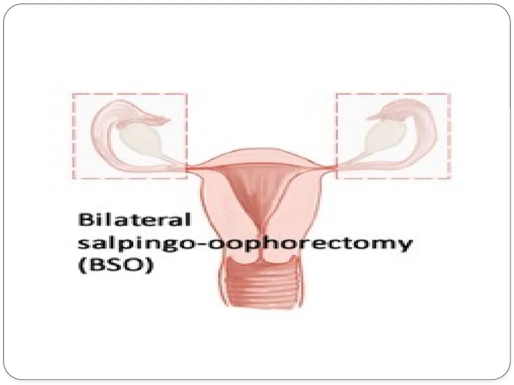Pelvic inflammatory disease prof. Dr. Rabea M. Ali - slide 40 of 44