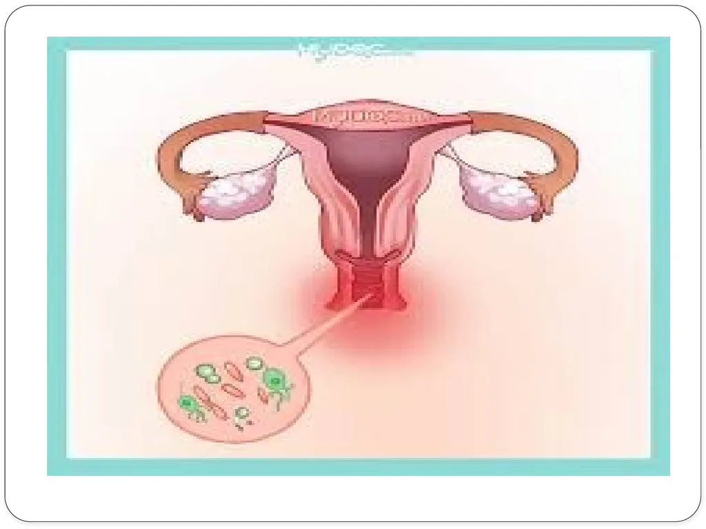 Pelvic inflammatory disease prof. Dr. Rabea M. Ali - slide 5 of 44