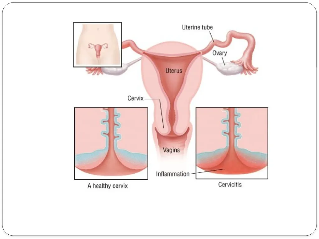Pelvic inflammatory disease prof. Dr. Rabea M. Ali - slide 7 of 44