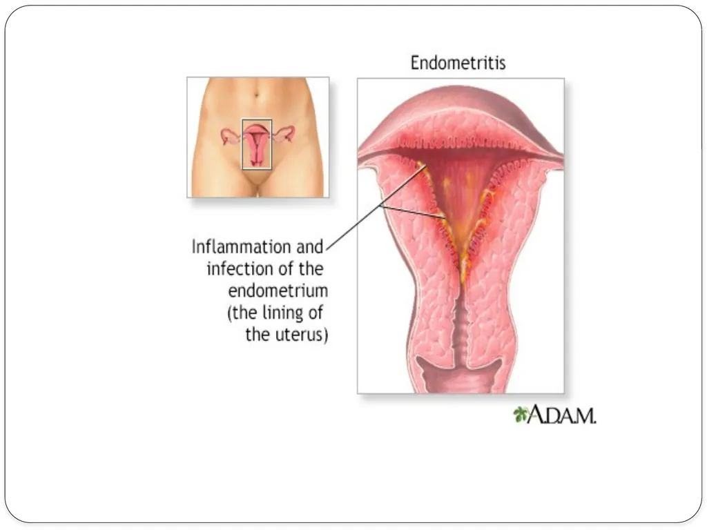 Pelvic inflammatory disease prof. Dr. Rabea M. Ali - slide 9 of 44