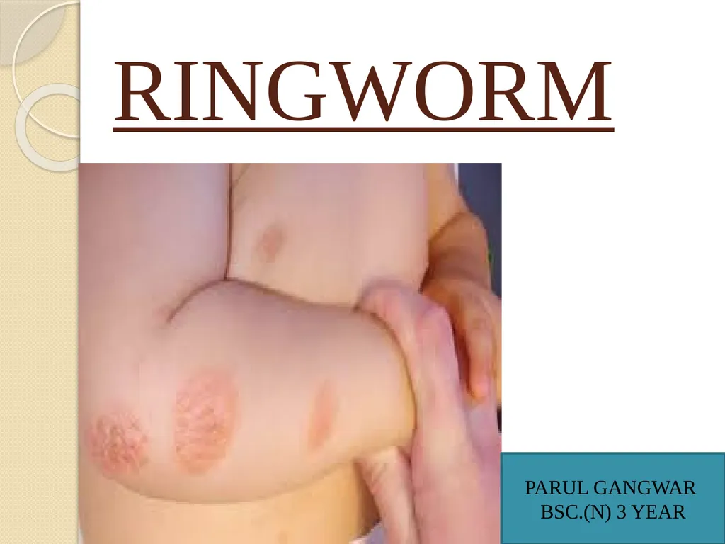 RINGWORM PARUL GANGWAR BSC.(N) 3 YEAR INTRODUCTION - slide 1 of 15