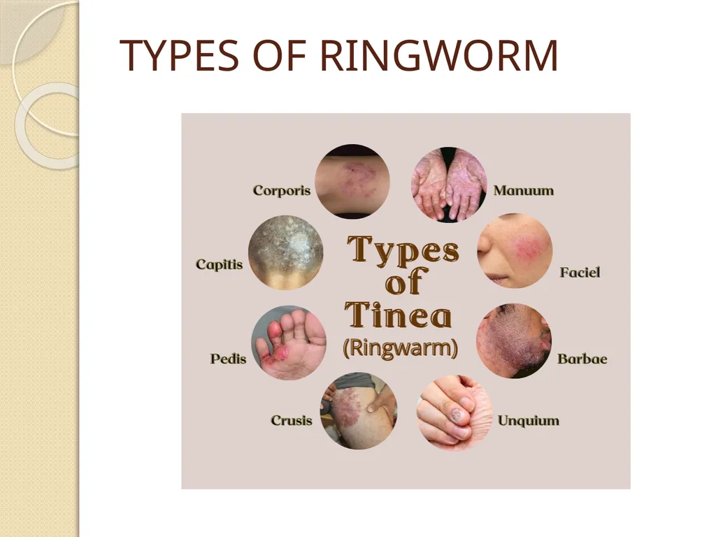 RINGWORM PARUL GANGWAR BSC.(N) 3 YEAR INTRODUCTION - slide 4 of 15