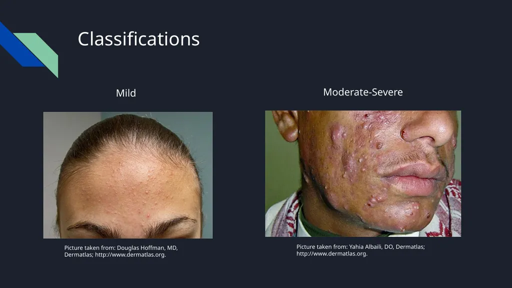 Acne Vulgaris Scott Stadler, Pharmacy Intern - slide 5 of 15
