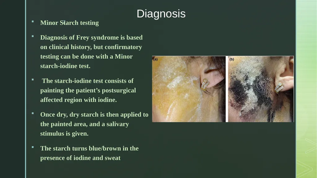 Frey’s Syndrome Frey syndrome was first described - slide 5 of 6