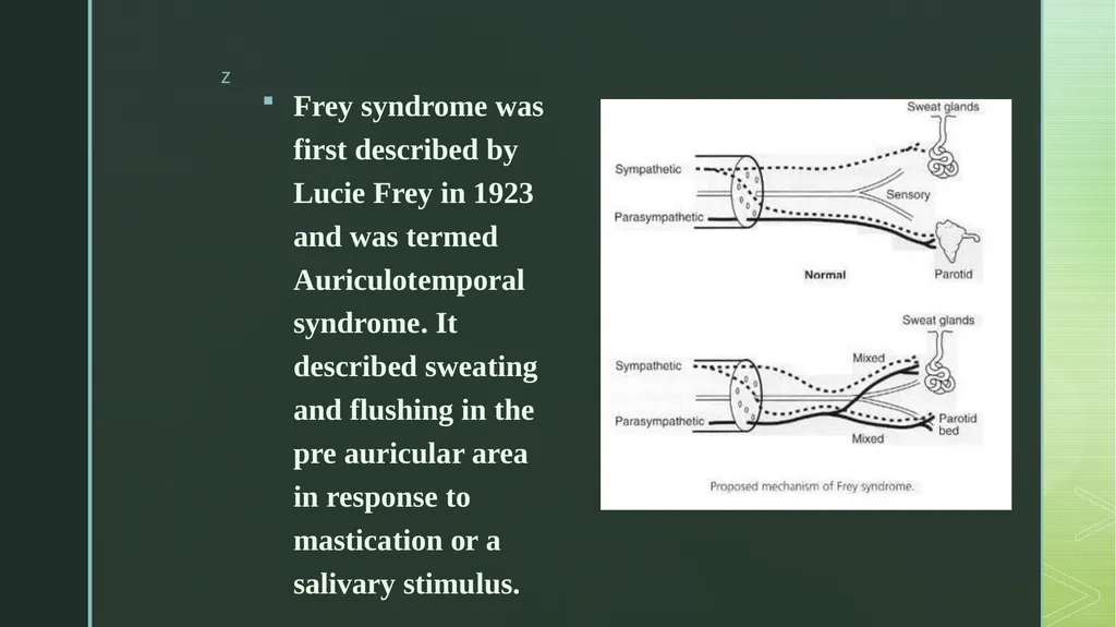 Frey’s Syndrome Frey syndrome was first described - slide 2 of 6