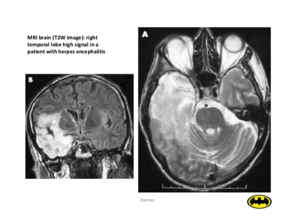 Viral Encepalitis BSc.3 Viral encephalitis is - slide 14 of 17