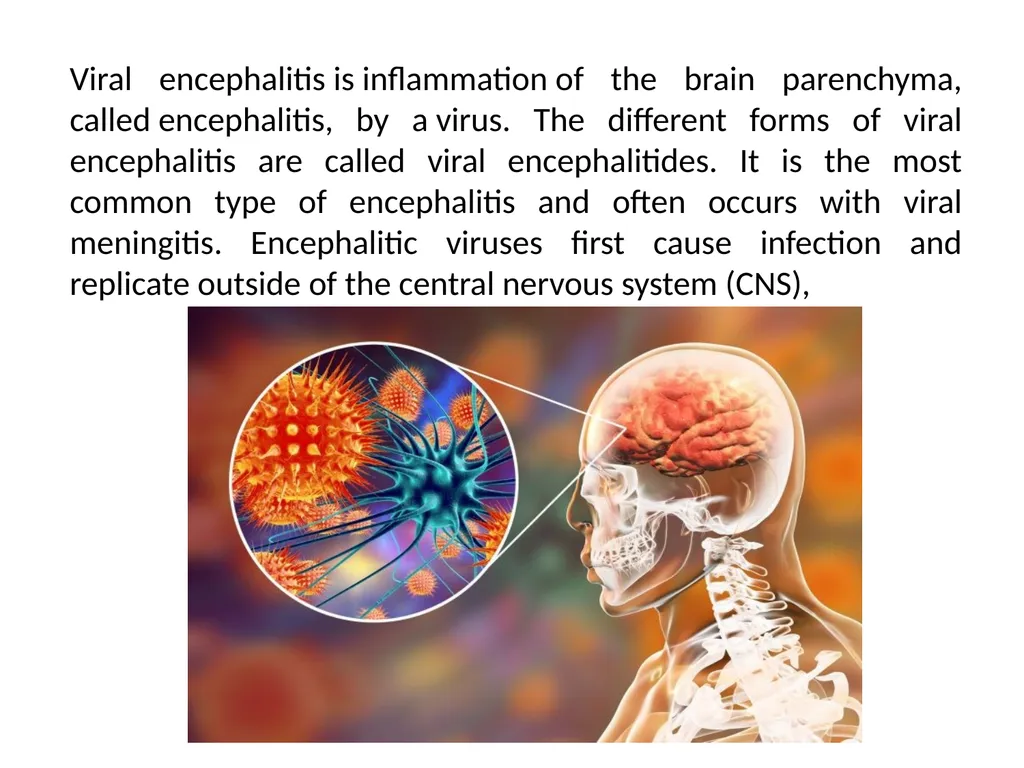 Viral Encepalitis BSc.3 Viral encephalitis is - slide 2 of 17