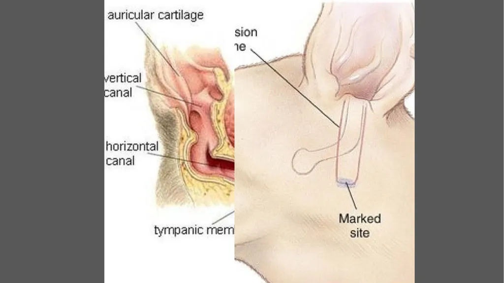 Lateral ear canal resection (Zepp’s - slide 4 of 6