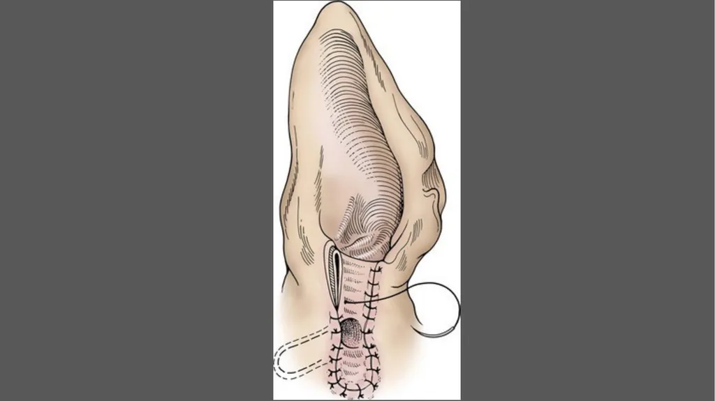 Lateral ear canal resection (Zepp’s - slide 6 of 6