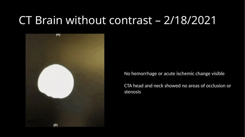Methotrexate-related Leukoencephalopathy Sungita - slide 5 of 20
