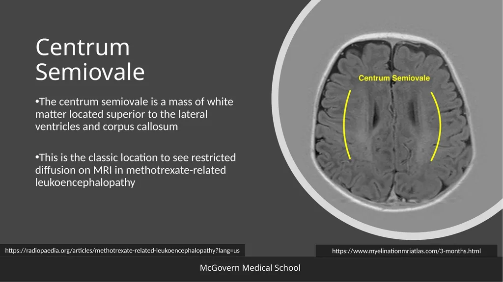 Methotrexate-related Leukoencephalopathy Sungita - slide 8 of 20