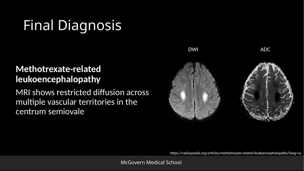 Methotrexate-related Leukoencephalopathy Sungita - slide 15 of 20