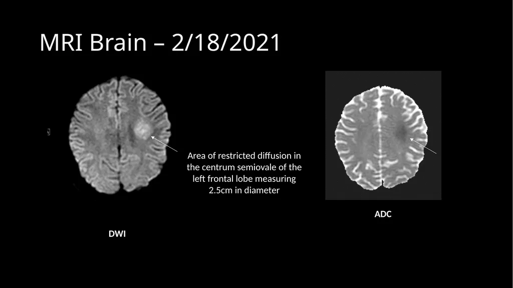 Methotrexate-related Leukoencephalopathy Sungita - slide 6 of 20