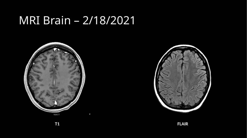 Methotrexate-related Leukoencephalopathy Sungita - slide 7 of 20