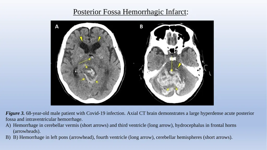 Retrospective Multicenter Study Of The - slide 13 of 20