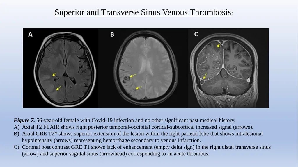 Retrospective Multicenter Study Of The - slide 17 of 20