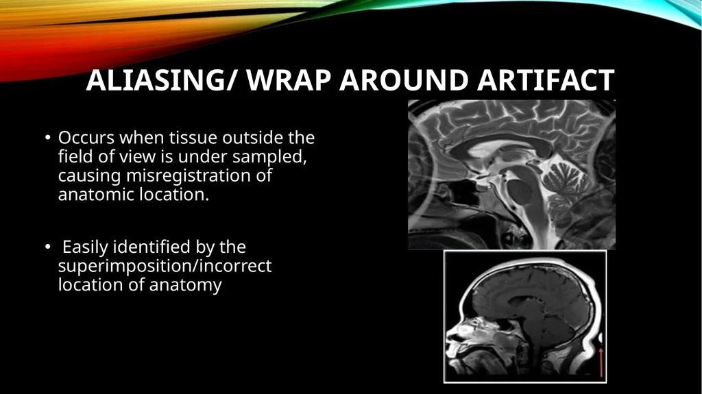 MRI ARTIFACTS What are artifacts? Artifacts are - slide 6 of 7