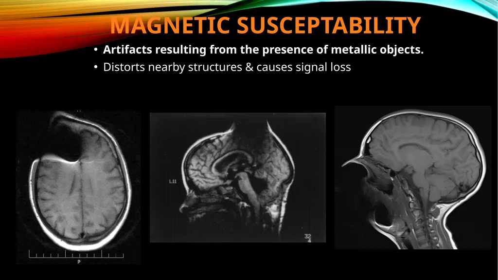 MRI ARTIFACTS What are artifacts? Artifacts are - slide 5 of 7