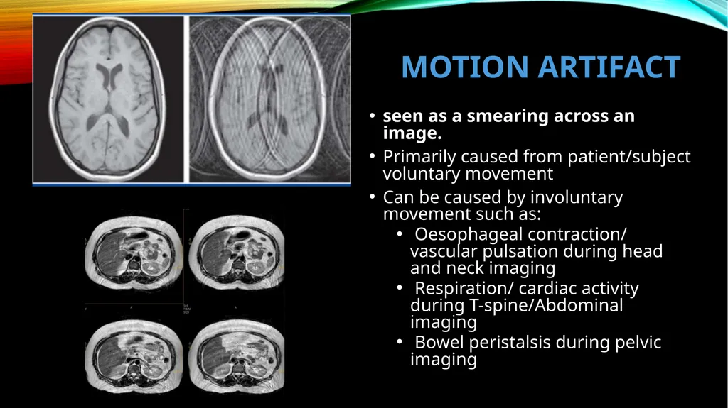 MRI ARTIFACTS What are artifacts? Artifacts are - slide 4 of 7
