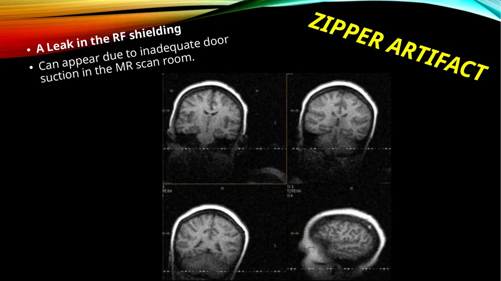 MRI ARTIFACTS What are artifacts? Artifacts are - slide 7 of 7
