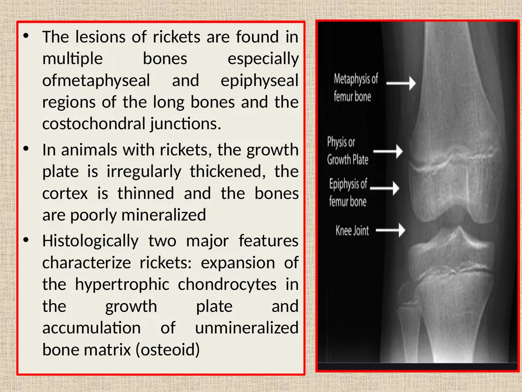 RICKETS VCM-609 Dr. Anil Kumar PG(Medicine) Dept. - slide 9 of 16