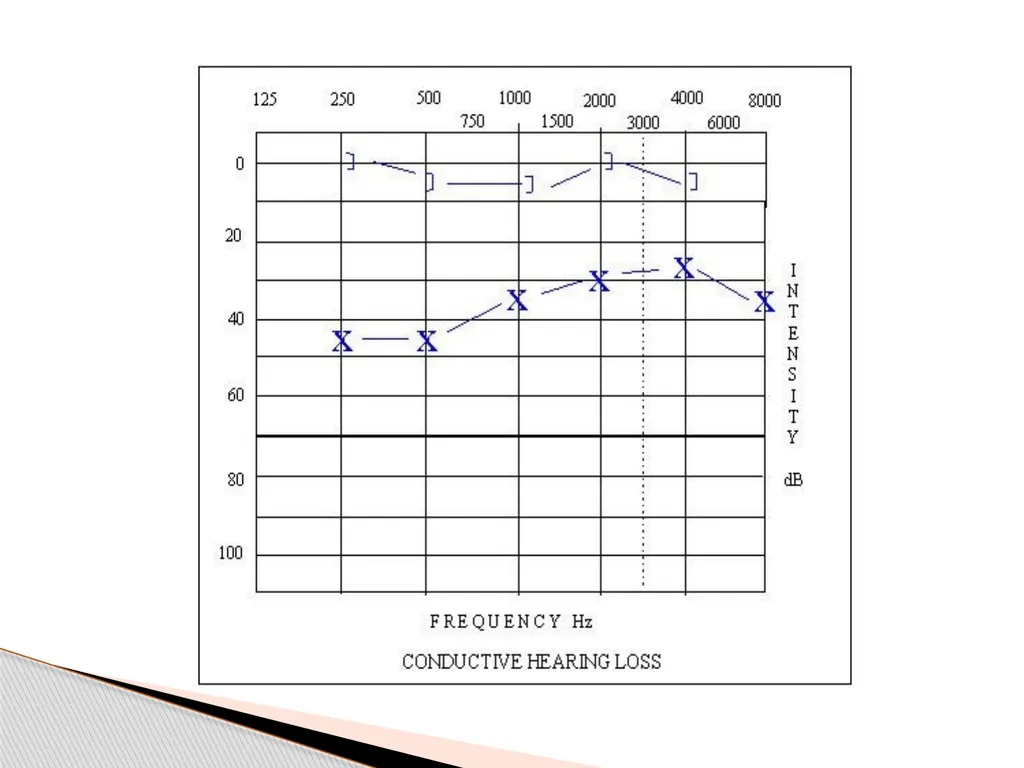 DEAFNESS,,,,,HEARING LOSS Asst.prof dr.FALIH - slide 17 of 48
