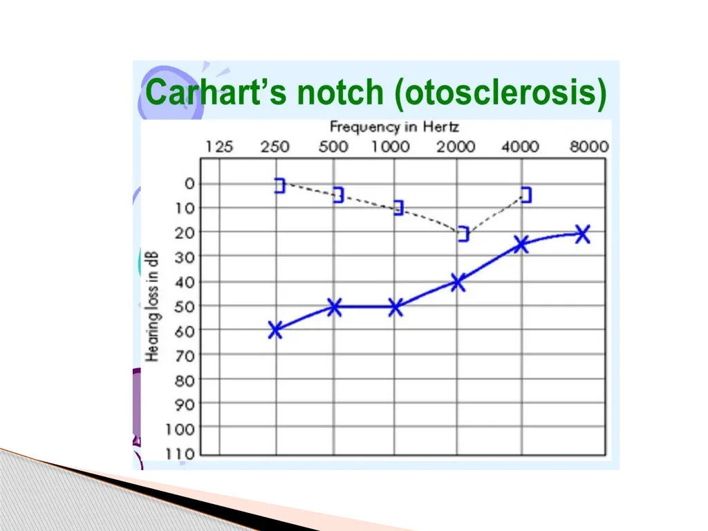 DEAFNESS,,,,,HEARING LOSS Asst.prof dr.FALIH - slide 28 of 48