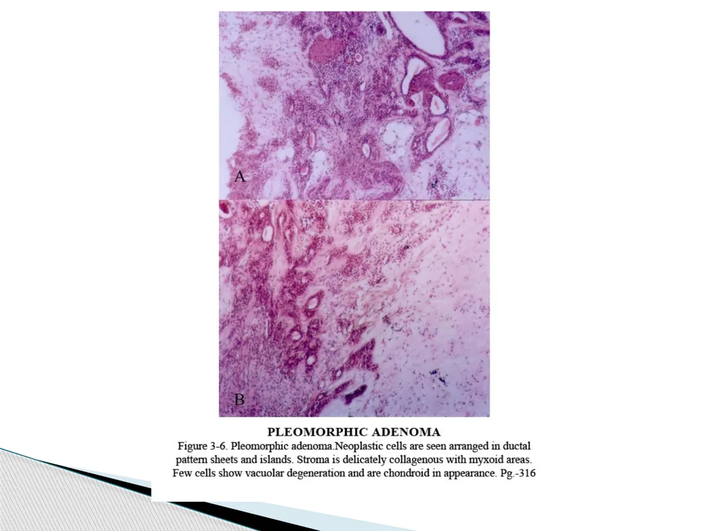 Adenomas Pleomorphic Adenoma Myoepithelioma Basal - slide 18 of 19