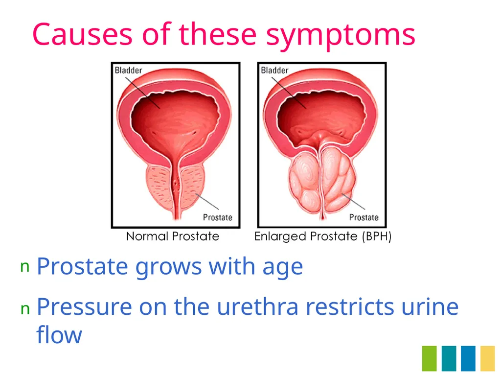 Benign Prostatic Hyperplasia The Prostate Gland - slide 7 of 37