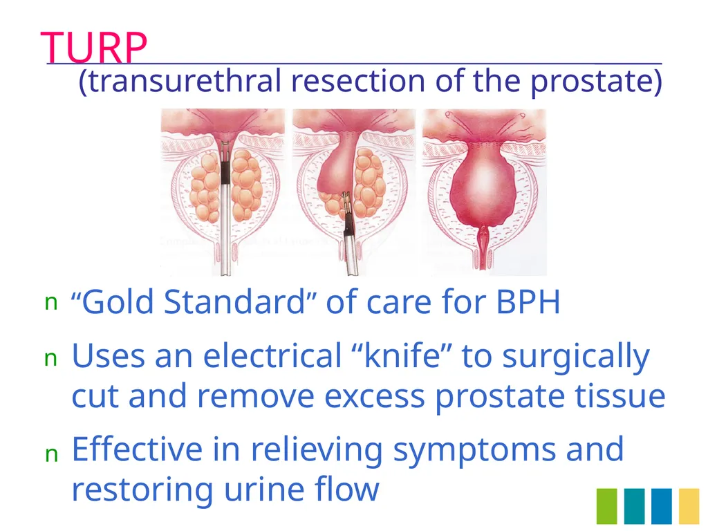 Benign Prostatic Hyperplasia The Prostate Gland - slide 34 of 37