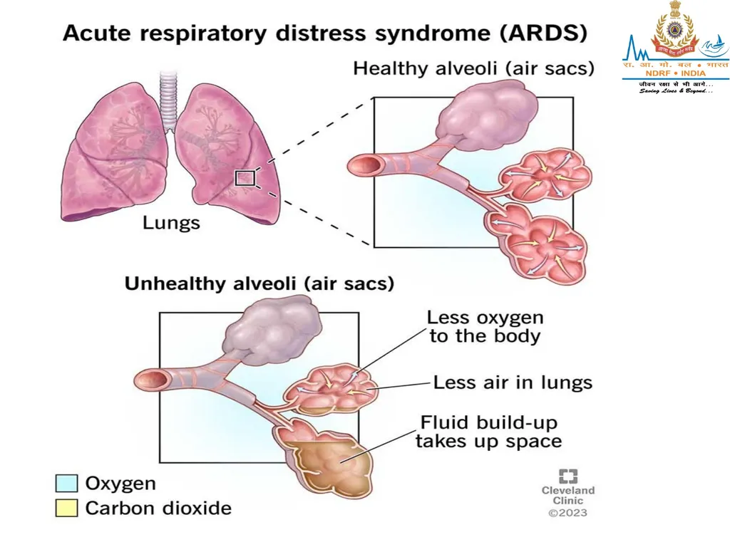 RESPIRATORY EMERGENCIES LESSON-16 BY JITENDER - slide 6 of 43