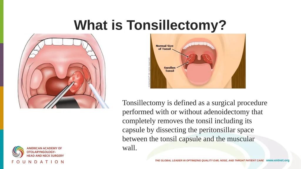 AAO-HNSF Clinical Practice Guideline (Update): - slide 2 of 56