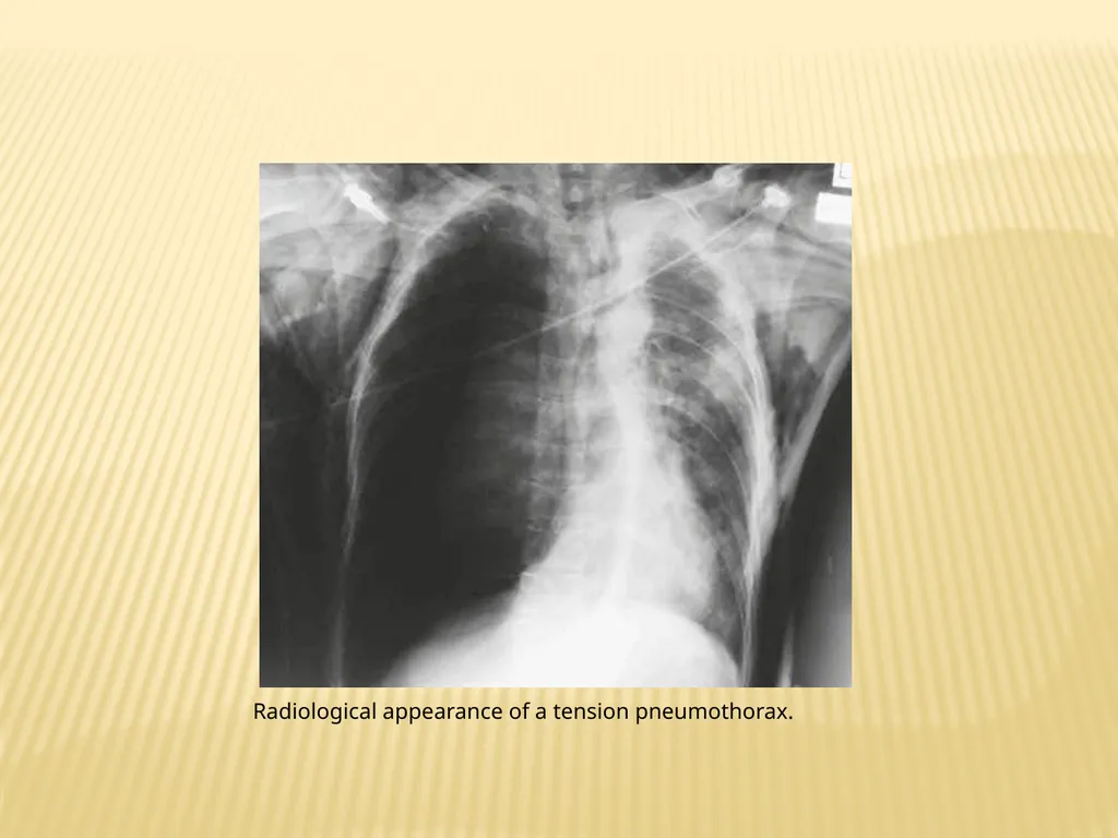 Trauma BY Dr ALI ADIL TRAUMA Trauma is the study - slide 35 of 53