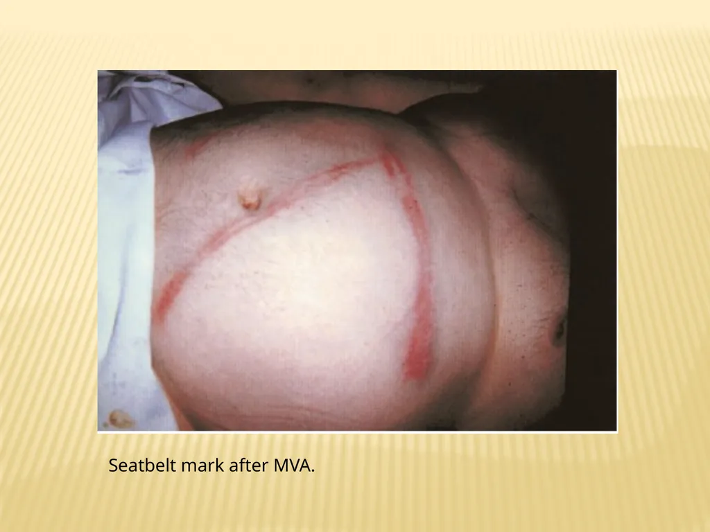 Trauma BY Dr ALI ADIL TRAUMA Trauma is the study - slide 12 of 53