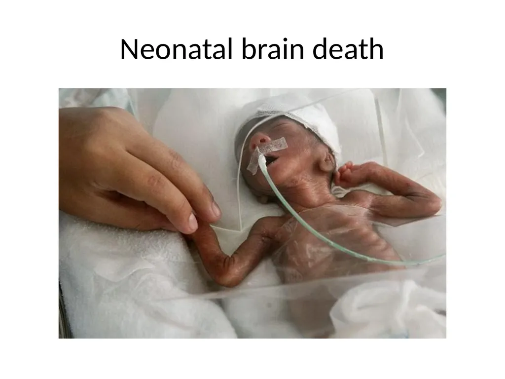 Brain death declaration in children Dr Lokesh - slide 15 of 53