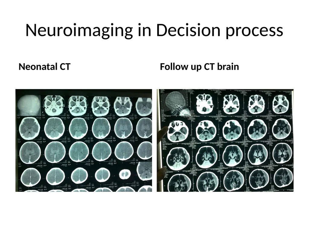 Brain death declaration in children Dr Lokesh - slide 23 of 53