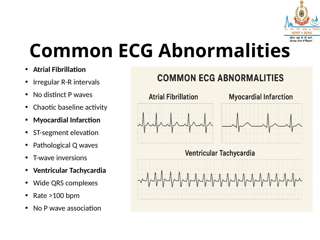 What is ECG? UNDERSTANDING ECG LESSON -2 By - slide 8 of 11