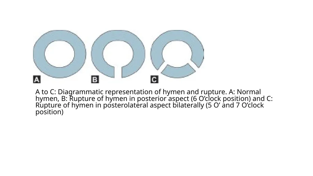 Virginity Medicolegal Importance A. Civil cases 1. - slide 13 of 17