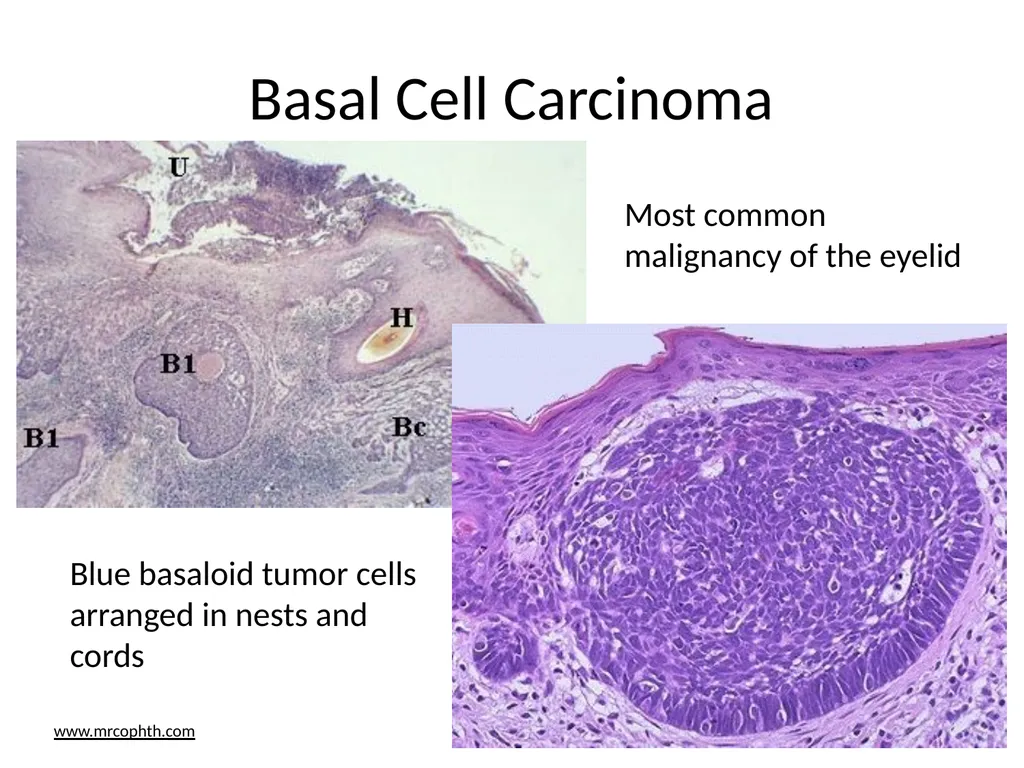 Clinical Pathology Case Chalazion Angela Elam, MD - slide 15 of 16
