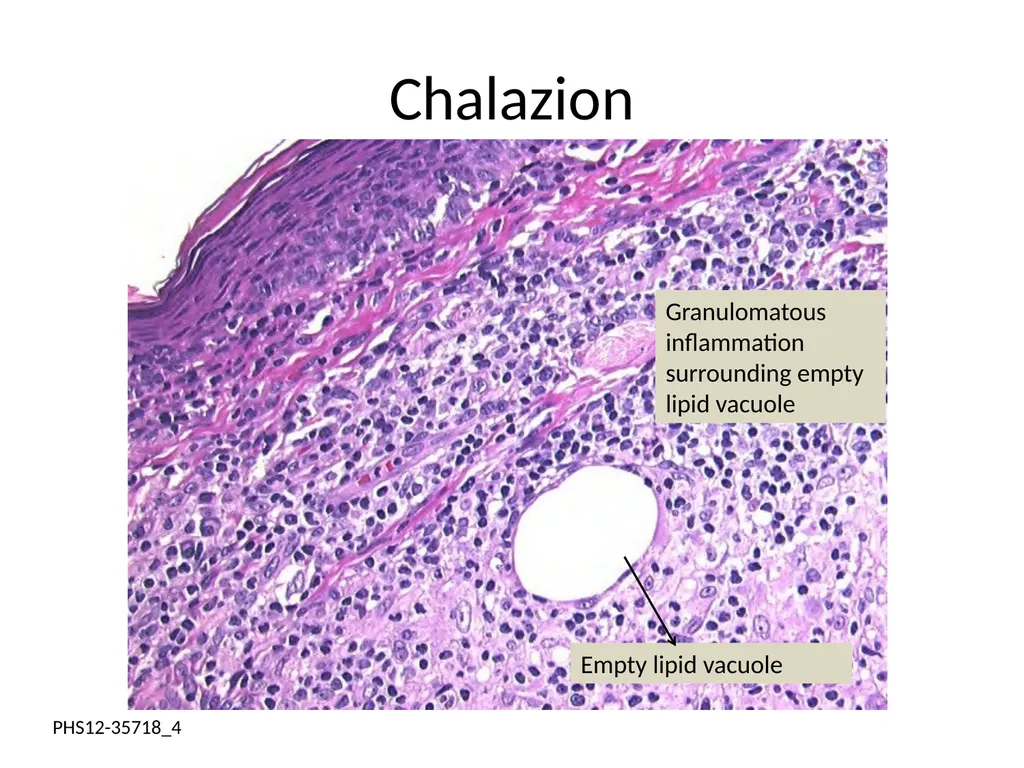 Clinical Pathology Case Chalazion Angela Elam, MD - slide 4 of 16