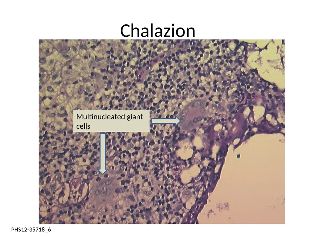 Clinical Pathology Case Chalazion Angela Elam, MD - slide 5 of 16