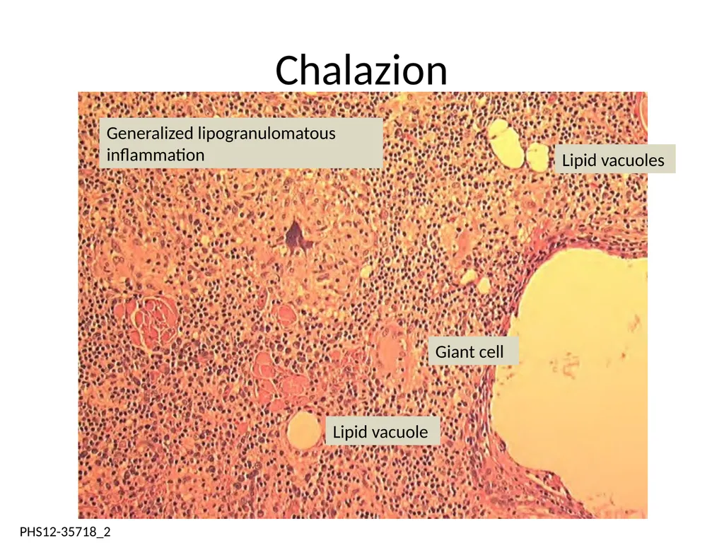 Clinical Pathology Case Chalazion Angela Elam, MD - slide 6 of 16