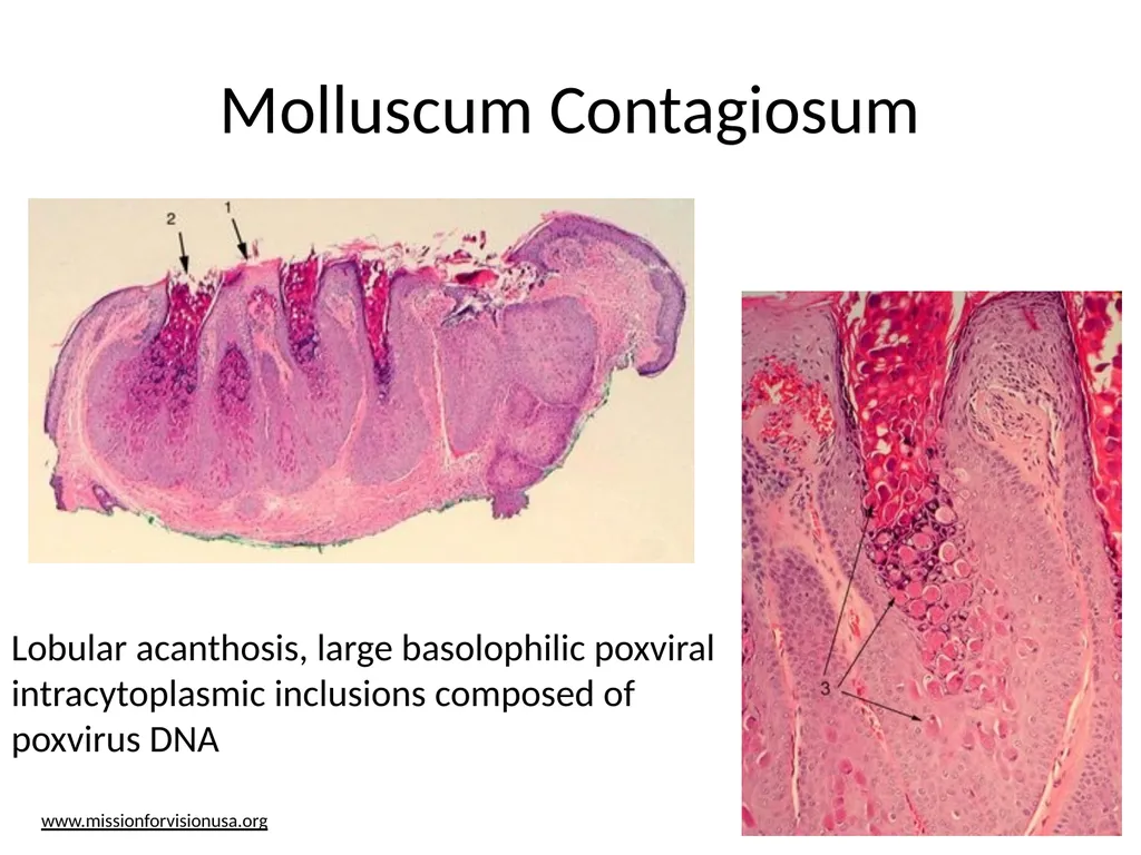 Clinical Pathology Case Chalazion Angela Elam, MD - slide 13 of 16