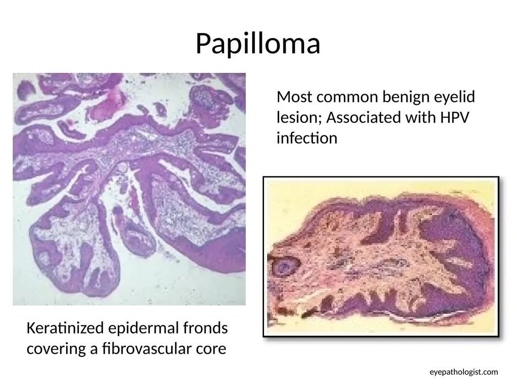 Clinical Pathology Case Chalazion Angela Elam, MD - slide 12 of 16