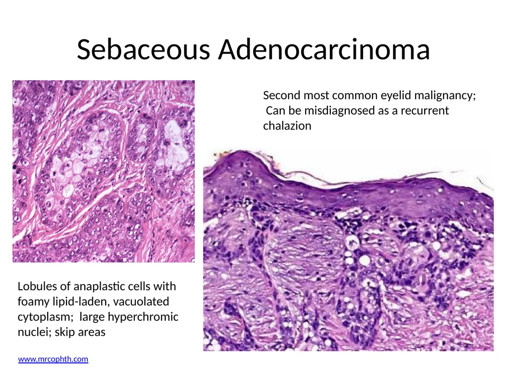 Clinical Pathology Case Chalazion Angela Elam, MD - slide 14 of 16