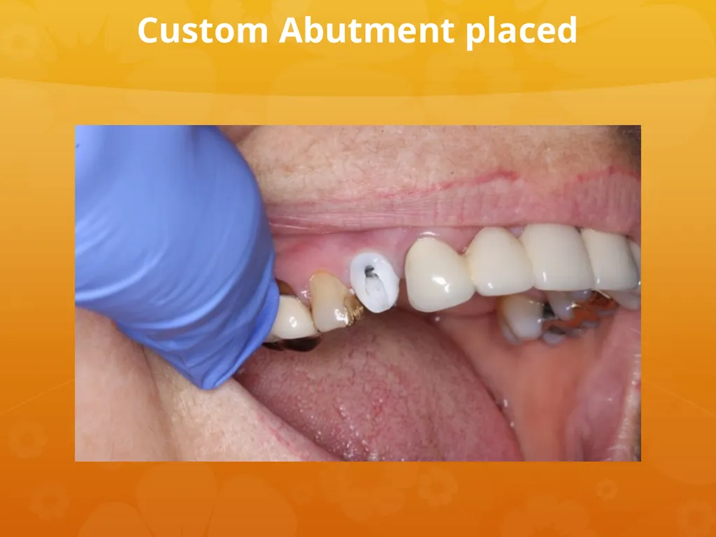 OCO Biomedical Custom Abutment and Crown With - slide 22 of 26