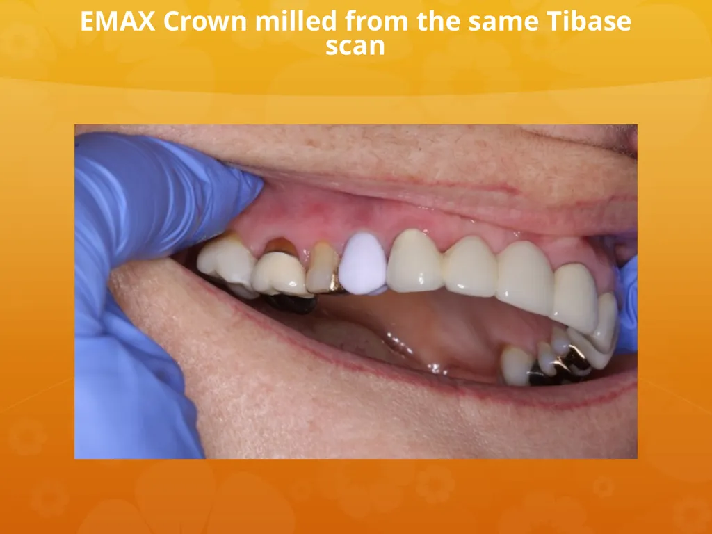 OCO Biomedical Custom Abutment and Crown With - slide 24 of 26